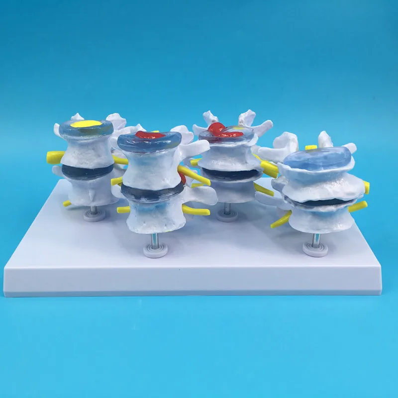 Quarter type Normal spine and Lumbar vertebrae pathological changes combined model High quality ne
Quarter type Normal spine and Lumbar vertebrae pathological changes combined model High quality ne