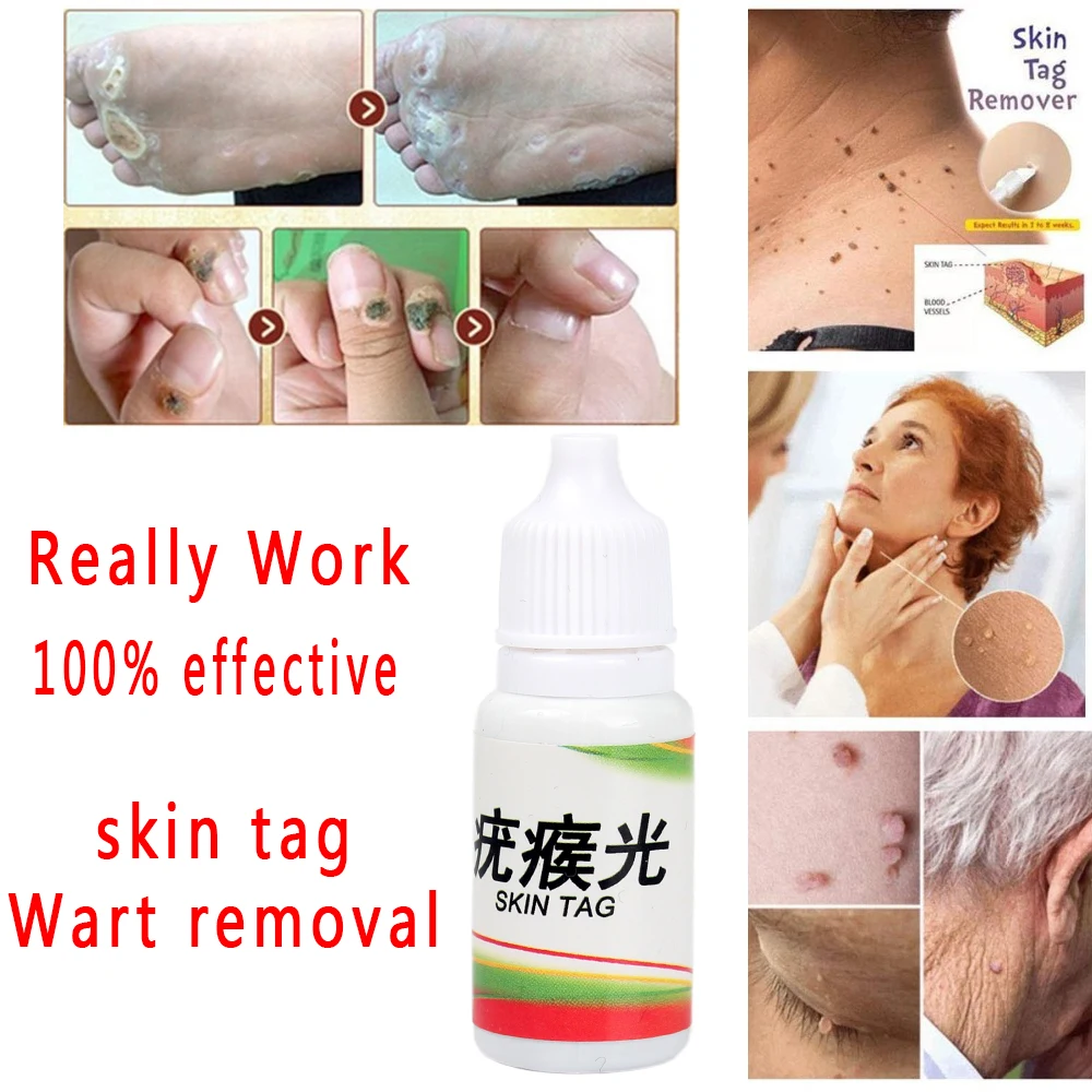 10ml Skin Tag Remover 12 hours Tu kill Medical Remover Foot Corn Skin Tag Mole & Genital Wart Skin Tag Remover
10ml Skin Tag Remover 12 hours Tu kill Medical Remover Foot Corn Skin Tag Mole & Genital Wart Skin Tag Remover