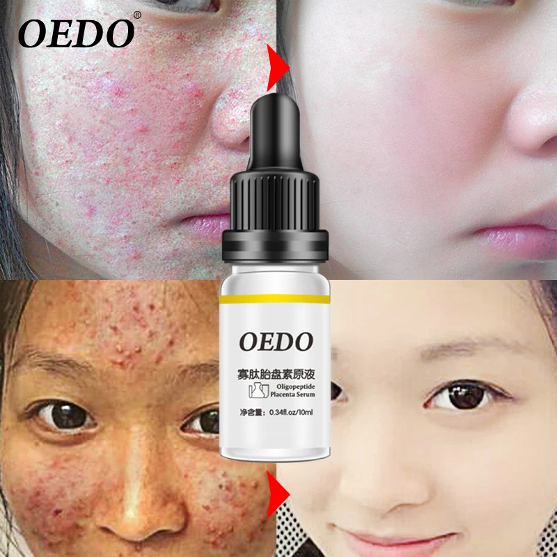 Hot Oligopeptide Placenta Acne Skin Rejuvenating Essence Liquid To Remove Acne Marks To Repair Facial Skin Whitening Fine Pores
Hot Oligopeptide Placenta Acne Skin Rejuvenating Essence Liquid To Remove Acne Marks To Repair Facial Skin Whitening Fine Pores