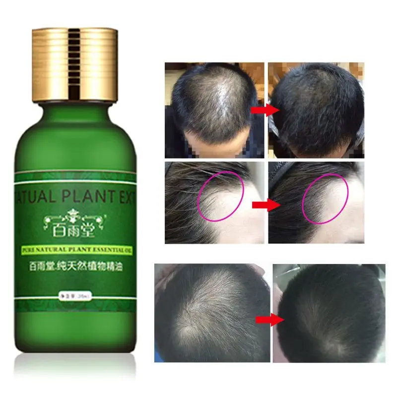 30ml Hair Care Hair Growth Essential Oils Essence Original Authentic 100% Hair Loss Liquid Health Care Dense Hair Growth Serum
30ml Hair Care Hair Growth Essential Oils Essence Original Authentic 100% Hair Loss Liquid Health Care Dense Hair Growth Serum