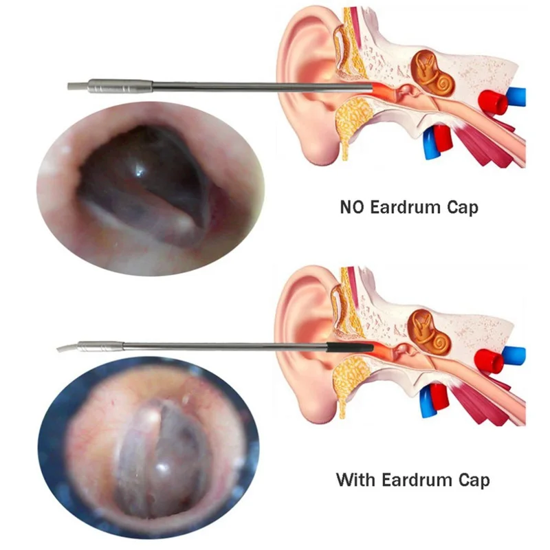 Ear otoscope Mini Camera Medical USB Endoscope for OTG Phone PC Borescope Inspection Otoscope Endoscope Camera for Ear nose Bod
Ear otoscope Mini Camera Medical USB Endoscope for OTG Phone PC Borescope Inspection Otoscope Endoscope Camera for Ear nose Bod