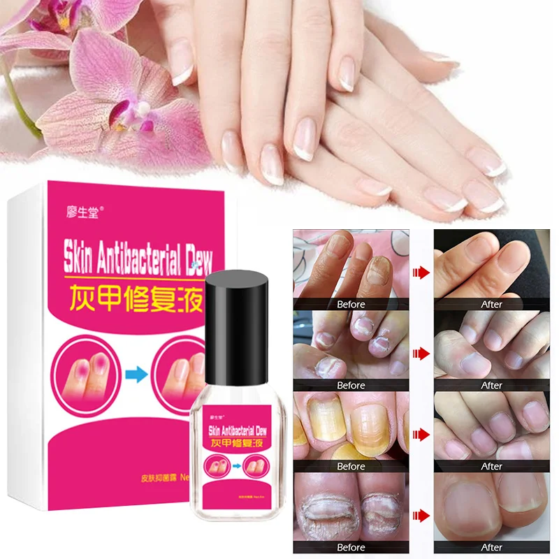 Nail Treatment Liquid Onychomycosis Paronychia Anti Fungal Nail Infection Chinese Herbal Toe Nail Fungus Treatment Repair TSLM2
Nail Treatment Liquid Onychomycosis Paronychia Anti Fungal Nail Infection Chinese Herbal Toe Nail Fungus Treatment Repair TSLM2