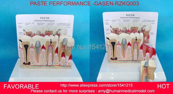 PATHOLOGICAL DENTAL MODEL TOOTH TEETH DENTIST,ORAL DENTAL TEACHING MODEL PASTE PERFORMANCE WITH EXPLANATION BOARD-GASEN-RZKQ003
PATHOLOGICAL DENTAL MODEL TOOTH TEETH DENTIST,ORAL DENTAL TEACHING MODEL PASTE PERFORMANCE WITH EXPLANATION BOARD-GASEN-RZKQ003