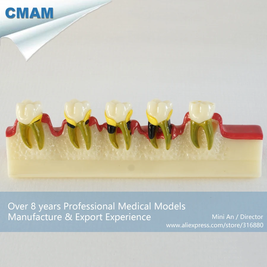 DH/13152, Root Caries Anatomy, Peridontal Diseases Developing Model, Educational Teaching Anatomical Models
DH/13152, Root Caries Anatomy, Peridontal Diseases Developing Model, Educational Teaching Anatomical Models