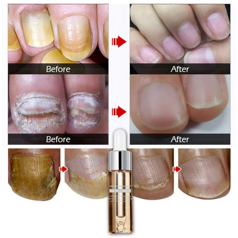 15ml Effective Liquid Nail Fungal Treatment Liquid Essence Anti Fungus Onychomycosis Nail Removal Repair Eye Care Hot
15ml Effective Liquid Nail Fungal Treatment Liquid Essence Anti Fungus Onychomycosis Nail Removal Repair Eye Care Hot