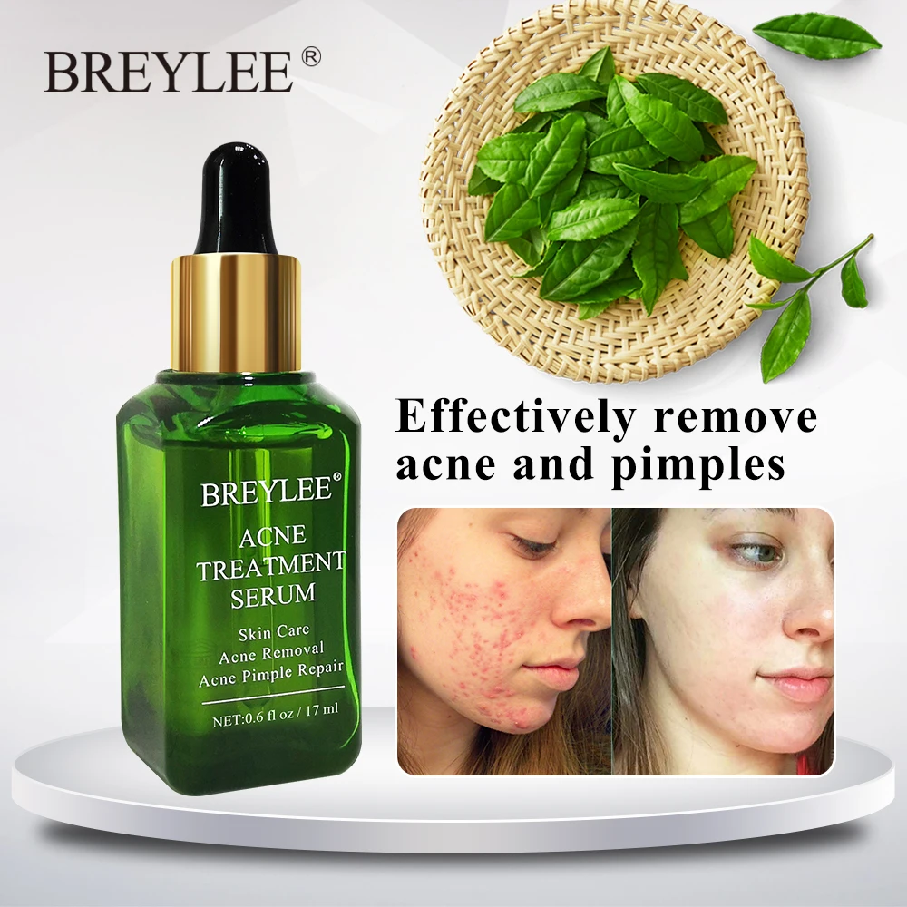 Breylee Acne Treatment Serum Face Facial Essence Anti Acne Scar Removal Cream Skin Care Whitening Repair Pimple Remover For Acne
Breylee Acne Treatment Serum Face Facial Essence Anti Acne Scar Removal Cream Skin Care Whitening Repair Pimple Remover For Acne