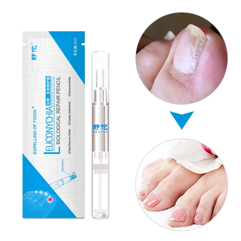 Good Result Nail Treatment Pen Onychomycosis Paronychia Anti Fungal Nail Infection Chinese Herbal Toe Nail Fungus Treatment
Good Result Nail Treatment Pen Onychomycosis Paronychia Anti Fungal Nail Infection Chinese Herbal Toe Nail Fungus Treatment