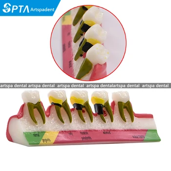 Dental Caries Demonstration Model Teeth Teaching Patient Disease Study Model
Dental Caries Demonstration Model Teeth Teaching Patient Disease Study Model