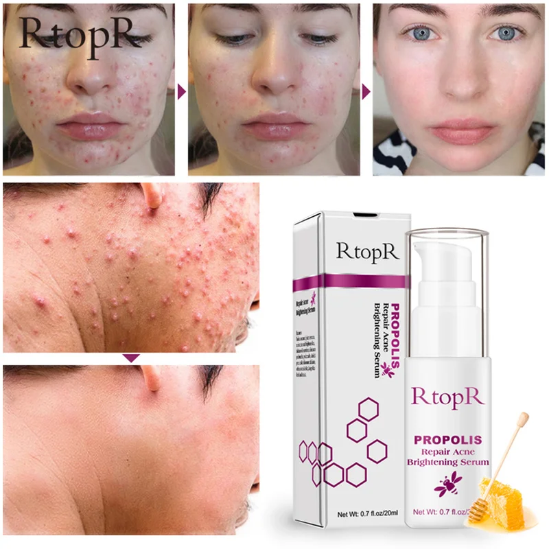 RtopR Propolis Repair Acne Brightening Serum Acne Scar Spots Cleaning Serum Shrink Pores Eliminates Treatment Oil control TSLM1
RtopR Propolis Repair Acne Brightening Serum Acne Scar Spots Cleaning Serum Shrink Pores Eliminates Treatment Oil control TSLM1
