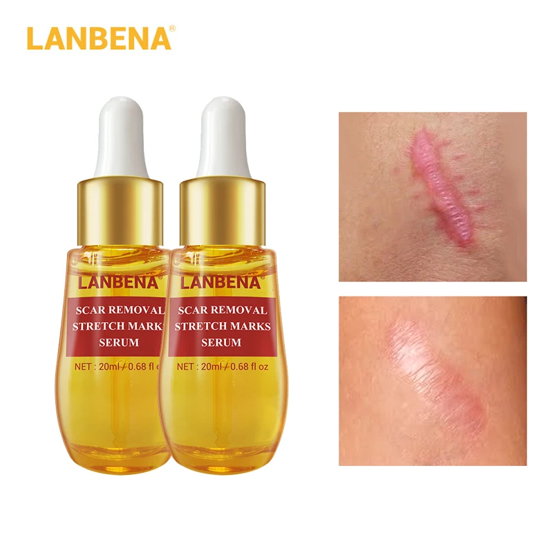 LANBENA 2pcs Acne Treatment Remover Stretch Marks Serum Skin Care Acne Scar Remove Cream Acne Shrink Pores Blackhead Whitening
LANBENA 2pcs Acne Treatment Remover Stretch Marks Serum Skin Care Acne Scar Remove Cream Acne Shrink Pores Blackhead Whitening