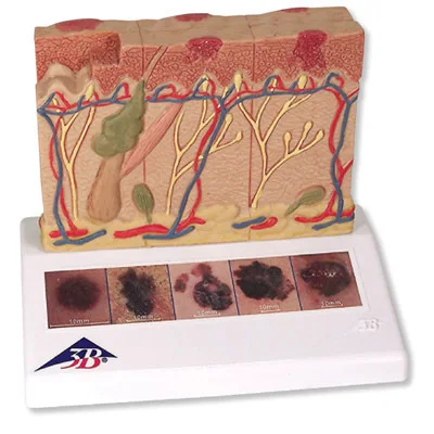 Melanoma melanocellular carcinoma six - stage skin display model 14*10*11.5cm 0.2kg
Melanoma melanocellular carcinoma six - stage skin display model 14*10*11.5cm 0.2kg