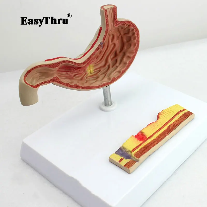 Gastric Ulcer Model Perforation Gastric Anatomical Pathology Model Use Gastroenterology Digestive System Model Medical Science
Gastric Ulcer Model Perforation Gastric Anatomical Pathology Model Use Gastroenterology Digestive System Model Medical Science