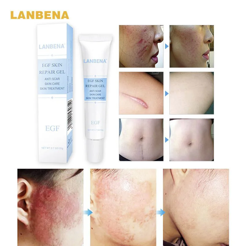 LANBENA EGF Skin Repair Gel Scar Removal Cream Moisturizing Acne Treatments Repair Damage Skin Remove Pigment Anti Acne Cream
LANBENA EGF Skin Repair Gel Scar Removal Cream Moisturizing Acne Treatments Repair Damage Skin Remove Pigment Anti Acne Cream