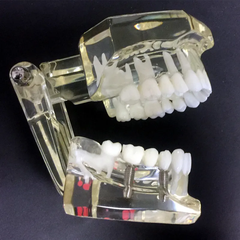 Dental Implant Disease Teeth Model With Restoration Bridge Malocclusion Orthodontic Model For Medical Science Dental Research
Dental Implant Disease Teeth Model With Restoration Bridge Malocclusion Orthodontic Model For Medical Science Dental Research