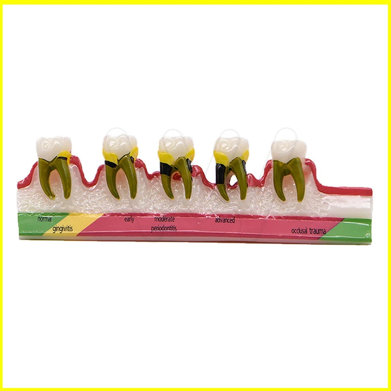 Dental-Caries-Demonstration-Model-Teeth-Teaching-Patient-Disease-_57 (2)