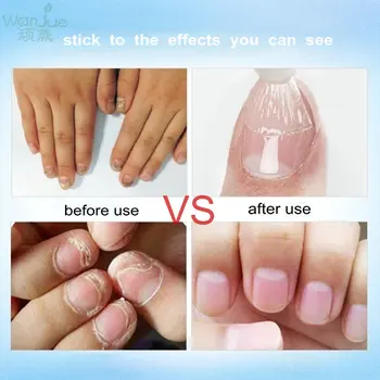 1 Pcs Nail Treatment Onychomycosis Paronychia Anti Fungal Nail Infection Toe Nail Fungus Treatment Nail Repair Skin Care Tools
1 Pcs Nail Treatment Onychomycosis Paronychia Anti Fungal Nail Infection Toe Nail Fungus Treatment Nail Repair Skin Care Tools
