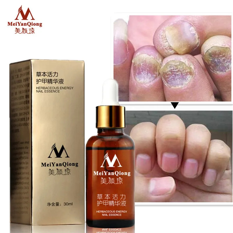Fungal Nail Treatment Essence Nail and Foot Whitening Toe Nail Fungus Removal Feet Nail Care Essential oil
Fungal Nail Treatment Essence Nail and Foot Whitening Toe Nail Fungus Removal Feet Nail Care Essential oil