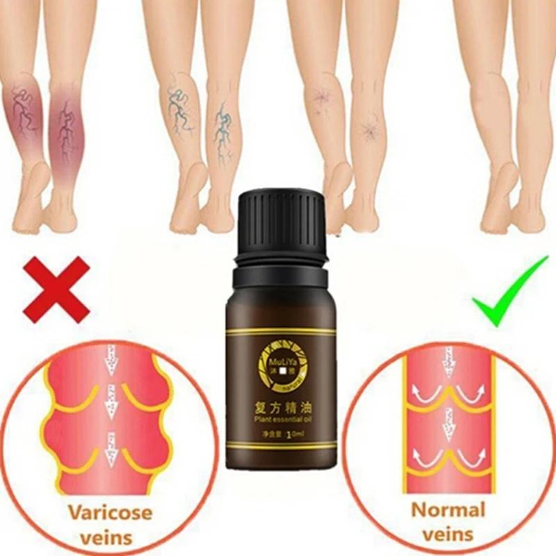 10ml Wormwood / Ginger / Jojoba Seed Essential Oil Varicose Veins Treatment Vasculitis Leg Acid Itching Herbal Care Ointment
10ml Wormwood / Ginger / Jojoba Seed Essential Oil Varicose Veins Treatment Vasculitis Leg Acid Itching Herbal Care Ointment
