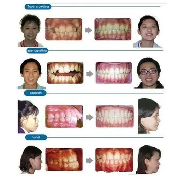 droppshiping Orthodontists Invisible Corrective Braces Upgraded Orthodontic Brackets MFJ99
droppshiping Orthodontists Invisible Corrective Braces Upgraded Orthodontic Brackets MFJ99