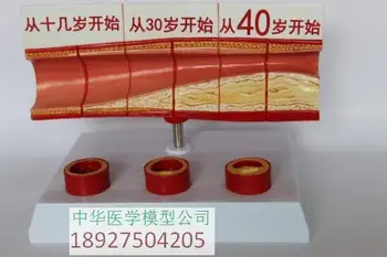 different age blood vessel anatomical model vascular atherosclerosis anatomy model
different age blood vessel anatomical model vascular atherosclerosis anatomy model