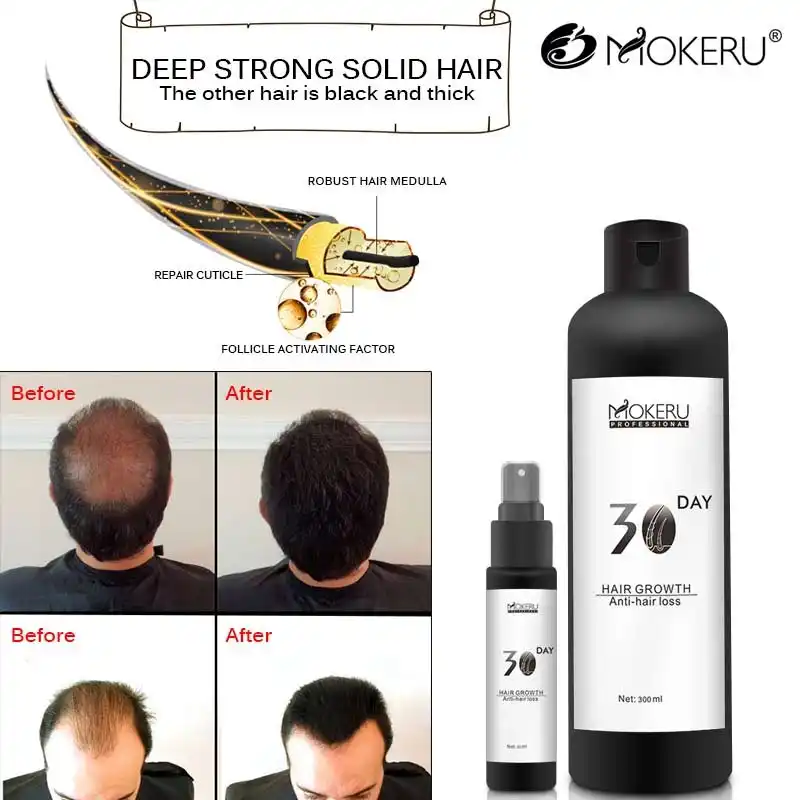 Mokeru المهنية العضوية زيت إنبات الشعر السائل رذاذ نمو الشعر مصل النفط مكافحة فقدان الشعر المنتجات للرجال والنساء منتجات تساقط الشعر Zawem