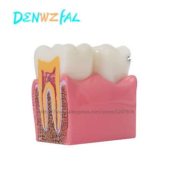 Six-fold dental caries contrast model dental decay demonstration model sectional model doctor-patient communication for teaching
Six-fold dental caries contrast model dental decay demonstration model sectional model doctor-patient communication for teaching