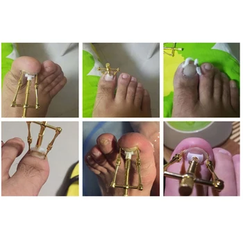 Updated Version Pure Copper Ingrowing Nail Orthotics Toe-nail Corrector Orthotics Gel Pain Relief Feet Health Care Tools 30
Updated Version Pure Copper Ingrowing Nail Orthotics Toe-nail Corrector Orthotics Gel Pain Relief Feet Health Care Tools 30