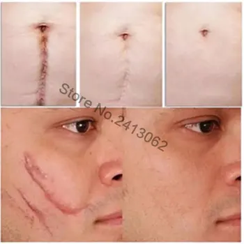 Natural Authentic Anti Acne Spots Face Anti Care Acne Treatment Scar Removal Oily Skin Acne Spots Skin Care Face Stretch Marks
Natural Authentic Anti Acne Spots Face Anti Care Acne Treatment Scar Removal Oily Skin Acne Spots Skin Care Face Stretch Marks