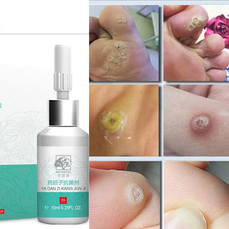 10ml Mole Skin Tag Repairing Solution Painless Tag Repair Freckle Repair Face Wart Mole Skin Cream can CSV
10ml Mole Skin Tag Repairing Solution Painless Tag Repair Freckle Repair Face Wart Mole Skin Cream can CSV
