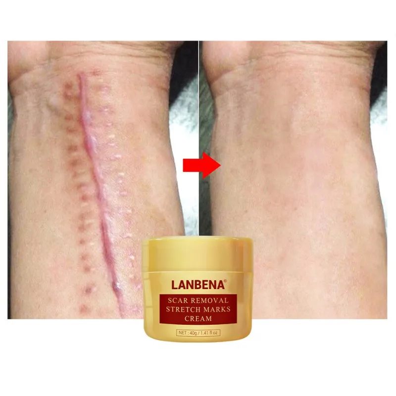 Hot Scar Removal Cream Acne Treatment Repairing Scar Blackhead Shrink Pores Whitening Moisturizing Skin Care 40g
Hot Scar Removal Cream Acne Treatment Repairing Scar Blackhead Shrink Pores Whitening Moisturizing Skin Care 40g