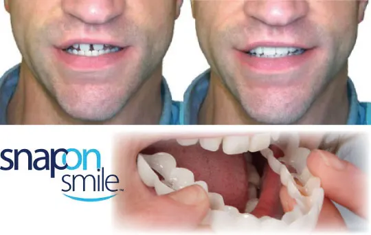 snap-on-smile-4-excellence-in-dentistry-levittown-ny-11756
