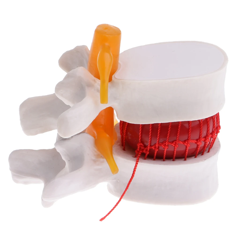 Magnification 2x Highly Detailed Human Lumbar Disc Protrusion Model Educative Study Tools Lab Ornament
Magnification 2x Highly Detailed Human Lumbar Disc Protrusion Model Educative Study Tools Lab Ornament