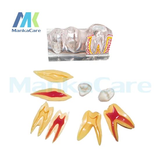 1 set Dental Implant Disease Teeth Model with Restoration Bridge Dentist for Medical Science Teaching 4 times teeth model
1 set Dental Implant Disease Teeth Model with Restoration Bridge Dentist for Medical Science Teaching 4 times teeth model