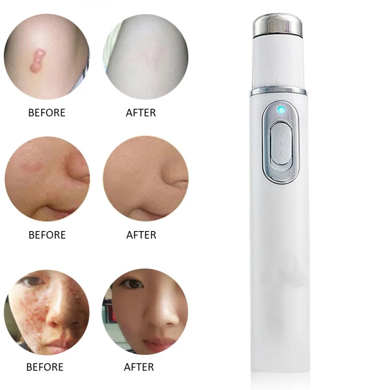 Portable Wrinkle Removal Machine Durable Soft Scar Remover Blue Light Therapy Pen Acne Laser Pen Massage spider vein Eraser
Portable Wrinkle Removal Machine Durable Soft Scar Remover Blue Light Therapy Pen Acne Laser Pen Massage spider vein Eraser