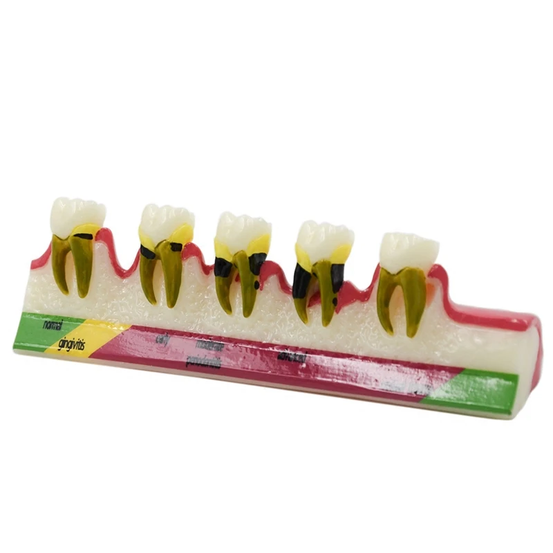 Хорошее качество стоматологический периодонтальный болезнь assort Teeth Dentoform, модель учебного обучения
Хорошее качество стоматологический периодонтальный болезнь assort Teeth Dentoform, модель учебного обучения