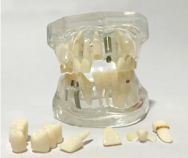 Transparent 1:1 Life Size Detachable Human Teeth Model Pathological Teeth Model Oral Dental Model Human Dental Anatomy
Transparent 1:1 Life Size Detachable Human Teeth Model Pathological Teeth Model Oral Dental Model Human Dental Anatomy