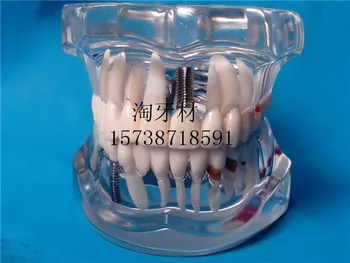 Dental Materials removable dental teeth model pathological tooth model Crystal Dental teeth Dental Materials
Dental Materials removable dental teeth model pathological tooth model Crystal Dental teeth Dental Materials