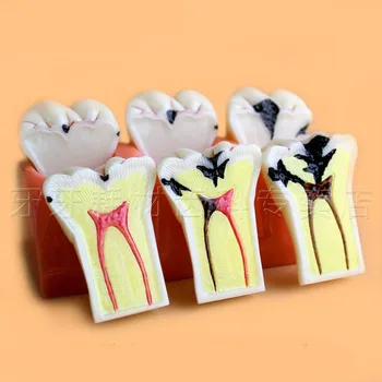 dental caries evolution model 4 times caries decomposition model Patient communication teeth model
dental caries evolution model 4 times caries decomposition model Patient communication teeth model