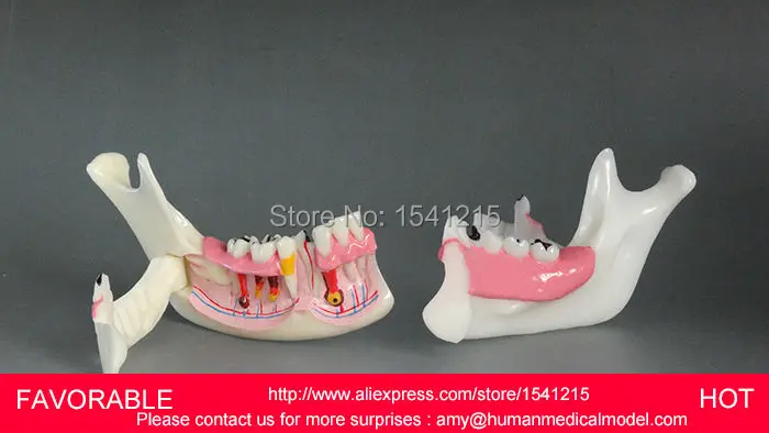 PATHOLOGICAL DENTAL MODEL TOOTH TEETH ,DENTAL MODEL ON THE RIGHT SIDE OF THE MANDIBLE ORGANIZATIONAL BREAKDOWN-GASEN-DEN051
PATHOLOGICAL DENTAL MODEL TOOTH TEETH ,DENTAL MODEL ON THE RIGHT SIDE OF THE MANDIBLE ORGANIZATIONAL BREAKDOWN-GASEN-DEN051