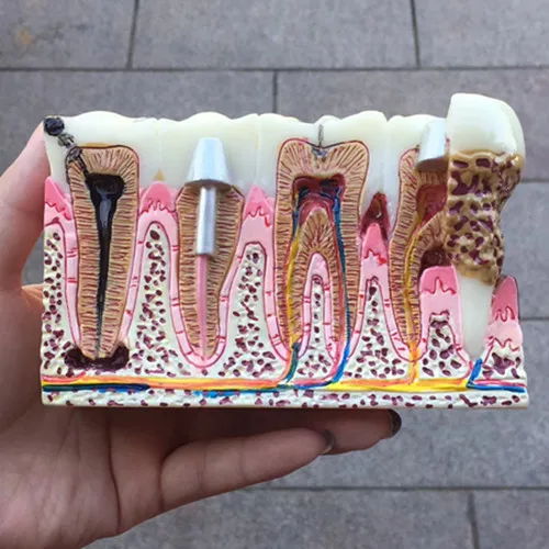1Pc Dental anatomy of dental caries teeth model demonstration dentist and patient communication Education teeth Model Equipment
1Pc Dental anatomy of dental caries teeth model demonstration dentist and patient communication Education teeth Model Equipment