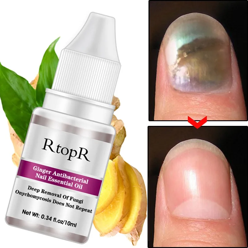 Nail and Foot Hand Care Whitening Toe Nail Anti Fungus Removal Infection Nail Gel Ginger Nail Treatment Repair Essence
Nail and Foot Hand Care Whitening Toe Nail Anti Fungus Removal Infection Nail Gel Ginger Nail Treatment Repair Essence