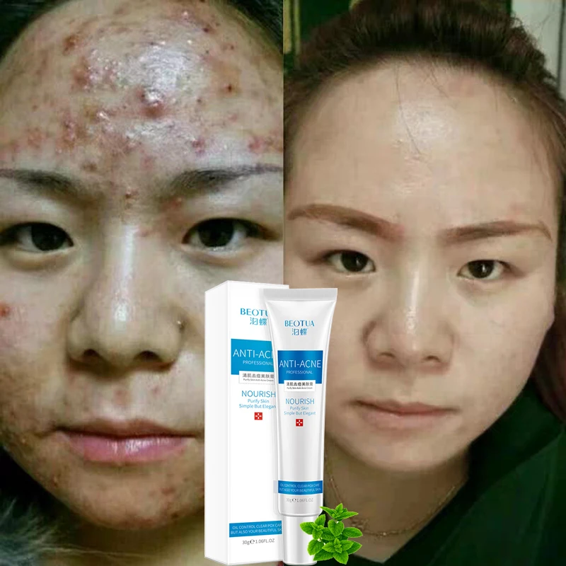 Anti-Acne Cream Nourish Purify Skin Simple But Elegant Face Serum Remover Acne Treatment Anti Spots Shrink Pores Oil Control
Anti-Acne Cream Nourish Purify Skin Simple But Elegant Face Serum Remover Acne Treatment Anti Spots Shrink Pores Oil Control