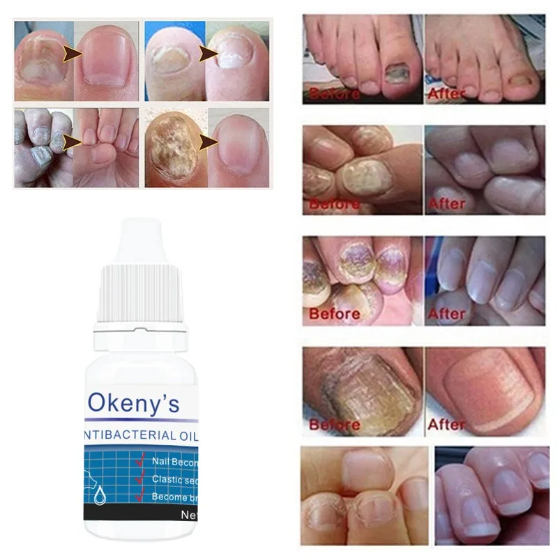 Powerful Nail Fungus Treatment for Toenail and Fingernail Fungus Onychomycosis Removal Antibacterial Oil
Powerful Nail Fungus Treatment for Toenail and Fingernail Fungus Onychomycosis Removal Antibacterial Oil