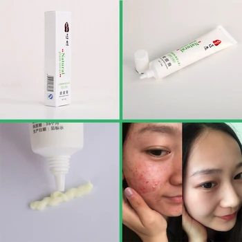 CAICUI 30g Anti Acne Cream / Oil Control / Shrink Pores/ Acne Scar Remove/ Face Care
CAICUI 30g Anti Acne Cream / Oil Control / Shrink Pores/ Acne Scar Remove/ Face Care