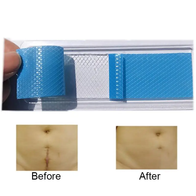 HOT SALE Caesarean Section Surgery Silicone Scar Removal Sheet Acne Trauma Burn Patch
HOT SALE Caesarean Section Surgery Silicone Scar Removal Sheet Acne Trauma Burn Patch