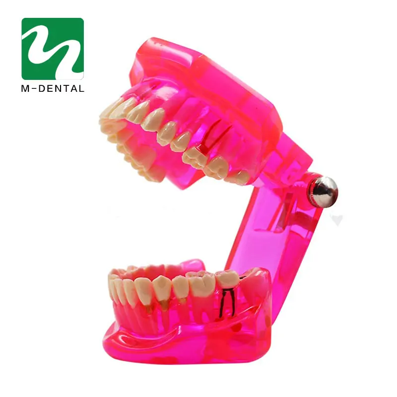 1 PC Dental Study Tooth Model Detachable Adult Pathological Teaching Teeth Model Transparent red
1 PC Dental Study Tooth Model Detachable Adult Pathological Teaching Teeth Model Transparent red