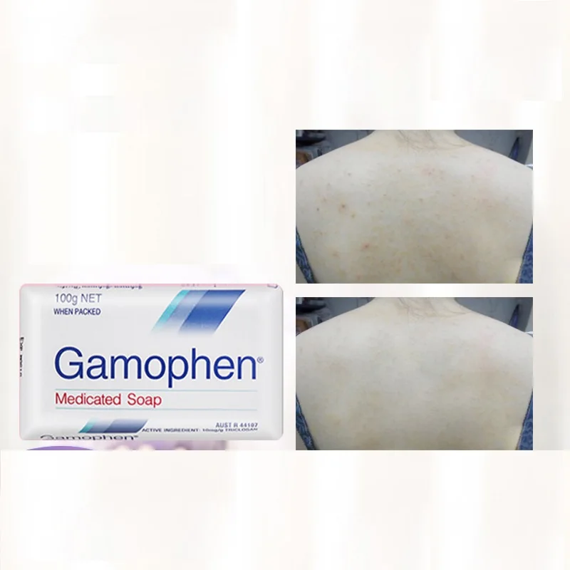 2P Australia Gamophen Antibacterial Medicated Soap Fight Acne Clean Blocked Pore Remove Excess Oil Give all-over Body Protection
2P Australia Gamophen Antibacterial Medicated Soap Fight Acne Clean Blocked Pore Remove Excess Oil Give all-over Body Protection