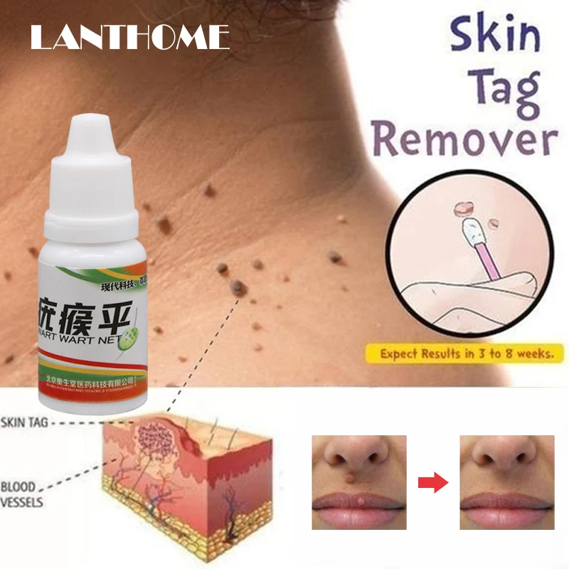 10ml Powerful Foot Corn Remover Useful Foot Callus Remover Liquid Body Warts Corn Mole Genital Wart Treatment Skin Tag Remover
10ml Powerful Foot Corn Remover Useful Foot Callus Remover Liquid Body Warts Corn Mole Genital Wart Treatment Skin Tag Remover
