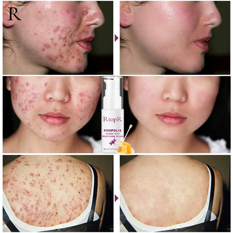 RtopR Propolis Repair Brightening Cleaning Shrink Pores Eliminates Acne Treatment H1
RtopR Propolis Repair Brightening Cleaning Shrink Pores Eliminates Acne Treatment H1