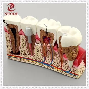 Dental Implant Teeth Model/Dentistry Disassembling Caries dental tooth Model/4times Caries teeth model
Dental Implant Teeth Model/Dentistry Disassembling Caries dental tooth Model/4times Caries teeth model